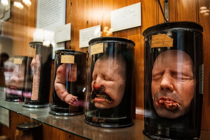 8. Modelos de cera de pacientes con enfermedades dermatológicas. Foto - Getty Images