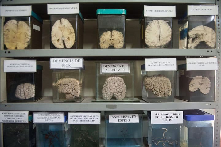 4. Cerebros con distintas patologías en el Museo del Cerebro. Foto - Getty Images